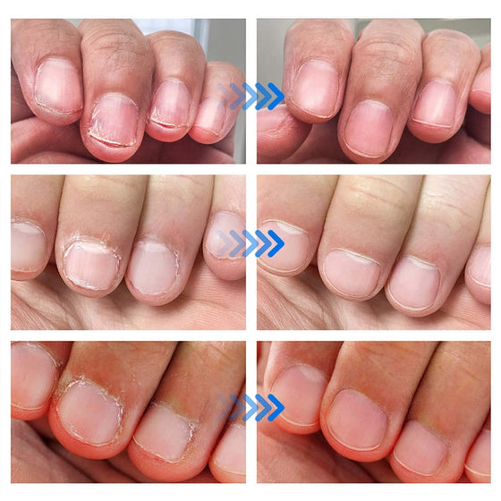 Lösning för svampdödande nagelreparation