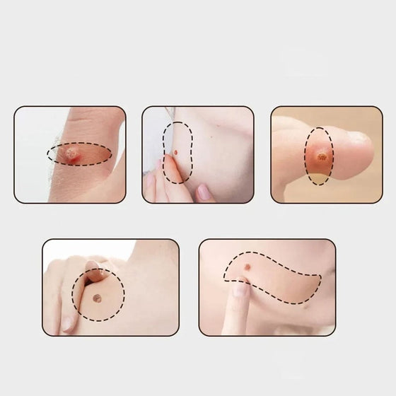 Anti-vårta/Hudflik kräm